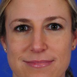Primary Rhinoplasty Before & After Patient #1653