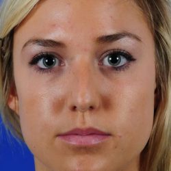 Primary Rhinoplasty Before & After Patient #1655