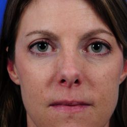 Revision Rhinoplasty Before & After Patient #1873