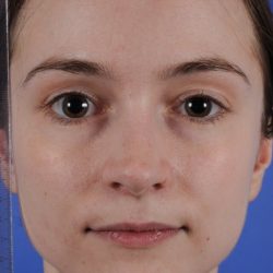 Revision Rhinoplasty Before & After Patient #1920