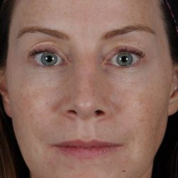Revision Rhinoplasty Before & After Patient #1921