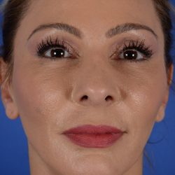 Revision Rhinoplasty Before & After Patient #1923