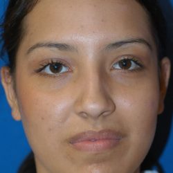 Ethnic Rhinoplasty Before & After Patient #1974