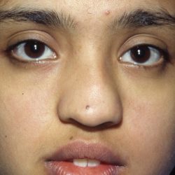 Ethnic Rhinoplasty Before & After Patient #2037
