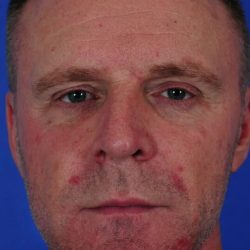 Primary Rhinoplasty Before & After Patient #1715
