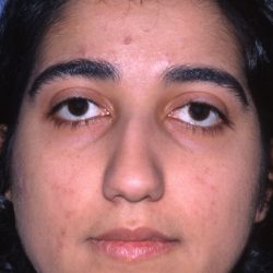 Ethnic Rhinoplasty Before & After Patient #2038