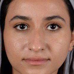 Ethnic Rhinoplasty Before & After Patient #2039
