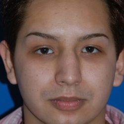 Ethnic Rhinoplasty Before & After Patient #2042