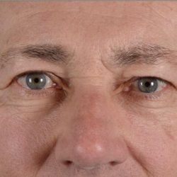 Blepharoplasty Before & After Patient #2165
