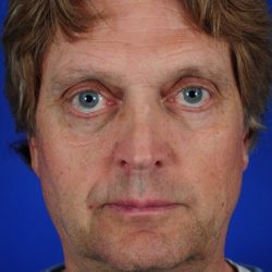 Face Lift - Neck Lift Before & After Patient #2233