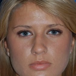 Primary Rhinoplasty Before & After Patient #1652