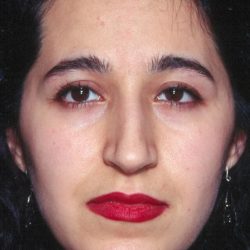 Primary Rhinoplasty Before & After Patient #1654