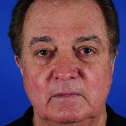 Face Lift - Neck Lift Before & After Patient #2235