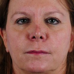 Face Lift - Neck Lift Before & After Patient #2236
