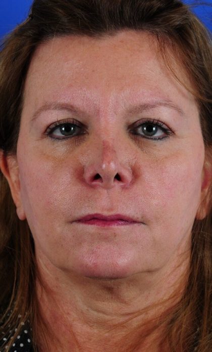 Facelift Neck Lift Before & After Patient #2236