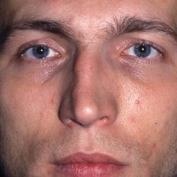Revision Rhinoplasty Before & After Patient #1823