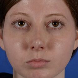 Revision Rhinoplasty Before & After Patient #1922