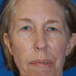 Face Lift - Neck Lift Before & After Patient #2274