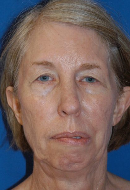 Facelift Neck Lift Before & After Patient #2274