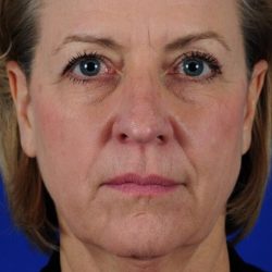 Face Lift - Neck Lift Before & After Patient #2275