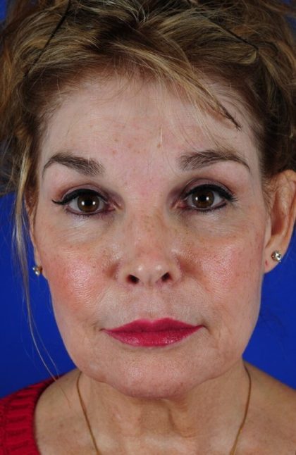 Facelift Neck Lift Before & After Patient #2276