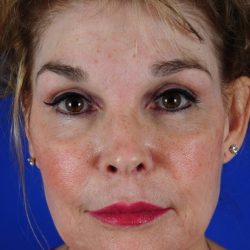 Facial Fat Transfer Before & After Patient #2324