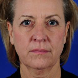 Facial Fat Transfer Before & After Patient #2326