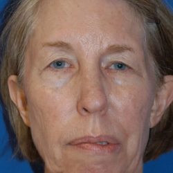 Facial Implants Before & After Patient #2113