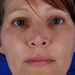 Revision Rhinoplasty Before & After Patient #1825