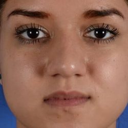 Buccal Fat Removal Before & After Patient #2114
