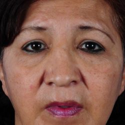 Revision Rhinoplasty Before & After Patient #1826