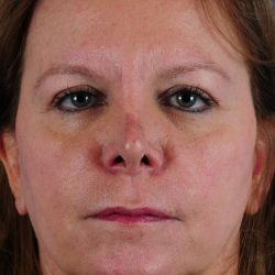 Revision Rhinoplasty Before & After Patient #1871