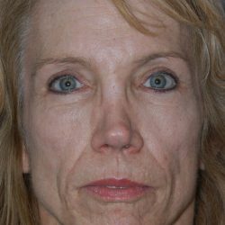 Revision Rhinoplasty Before & After Patient #1872