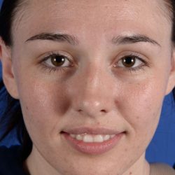 Primary Rhinoplasty Before & After Patient #1719