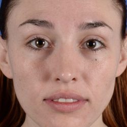 Primary Rhinoplasty Before & After Patient #1719