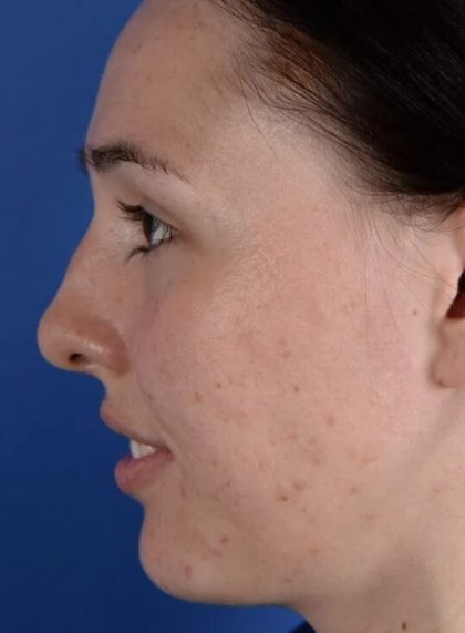 Primary Rhinoplasty Before & After Patient #1719