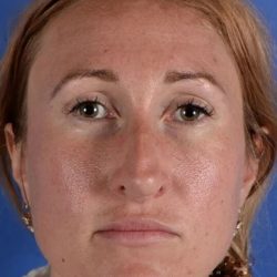 Revision Rhinoplasty Before & After Patient #1924