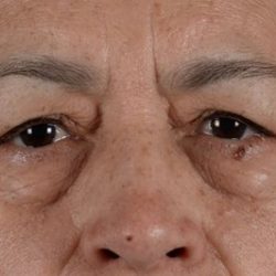 Blepharoplasty Before & After Patient #2166