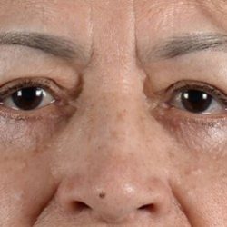 Blepharoplasty Before & After Patient #2166