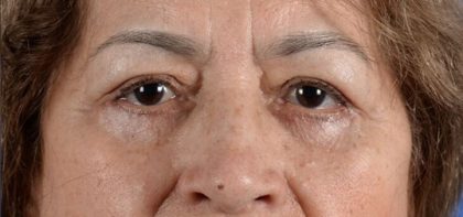 Blepharoplasty Before & After Patient #2166