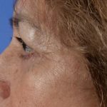 Blepharoplasty Before & After Patient #2166