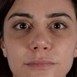 Revision Rhinoplasty Before & After Patient #1925