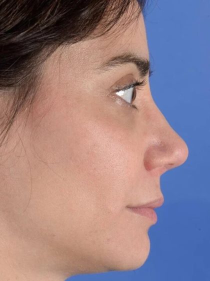 Revision Rhinoplasty Before & After Patient #1925