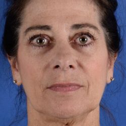Face Lift - Neck Lift Before & After Patient #2278