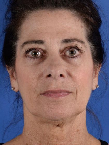 Facelift Neck Lift Before & After Patient #2278