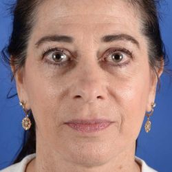 Face Lift - Neck Lift Before & After Patient #2278