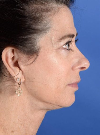 Facelift Neck Lift Before & After Patient #2278