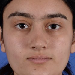 Ethnic Rhinoplasty Before & After Patient #1979