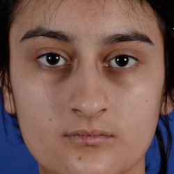 Ethnic Rhinoplasty Before & After Patient #1979