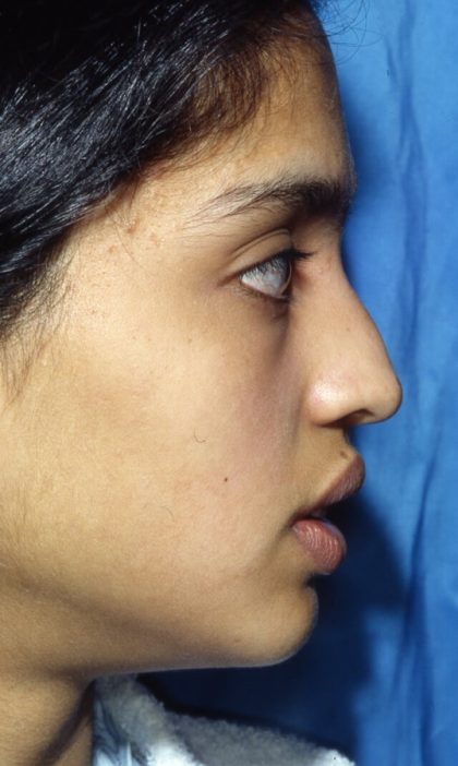 Ethnic Rhinoplasty Before & After Patient #2037